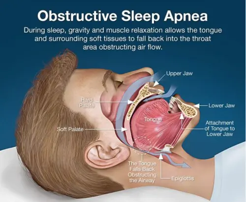 Causes of Sleep Apnea The Science Behind the Blockage-Taevas Life Sciences