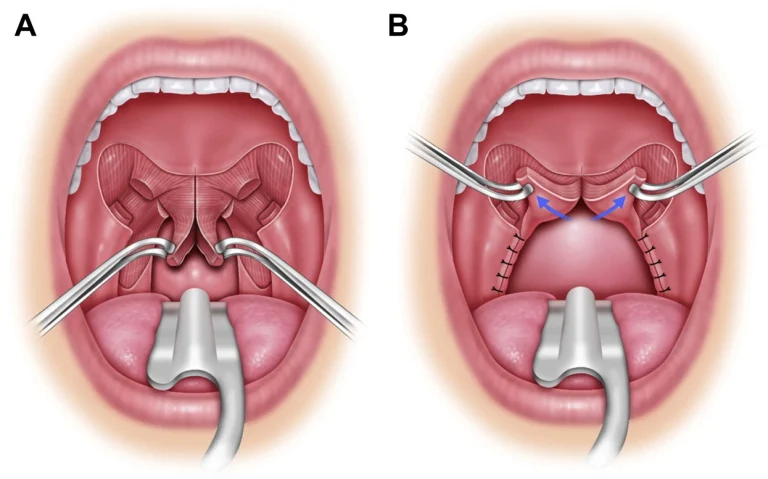 Upper Airway Surgery-Taevas Life Sciences