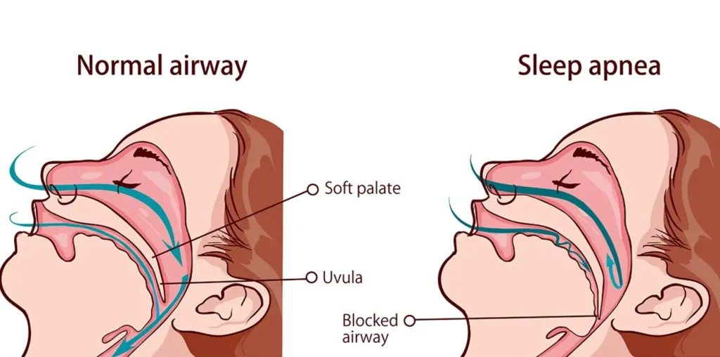What is Sleep Apnea-Taevas Life Sciences